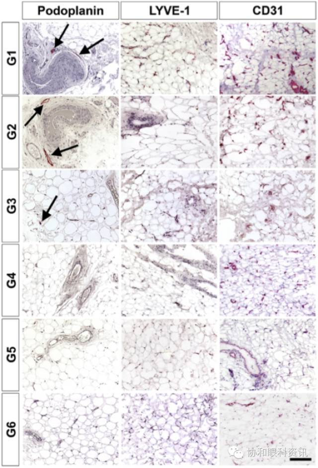 文摘速递TAO眶压升高,谁是幕后元凶?