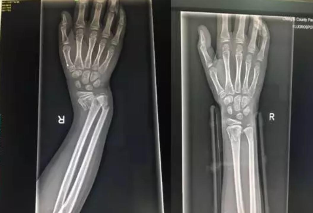 正骨治骨折的亲身经历,骨折有什么特效药治疗最好最快