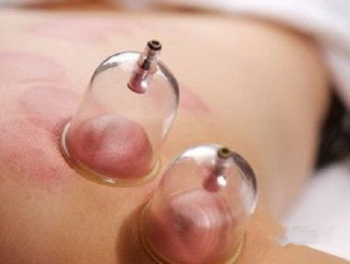 怎么通过拔罐的颜色判断身体状况,肩膀拔罐后颜色黑紫是怎么回事