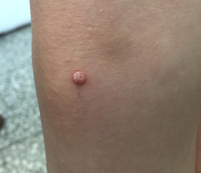 水瘊子去掉母瘊子还会长吗,肉瘊子用手抠了会怎样