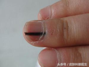 指甲上有很短的黑色线怎么回事,指甲上面出现一条黑线