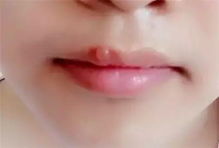 嘴唇和鼻子中间上火起泡快速消除,冬天嘴唇上火起泡干裂脱皮怎么办