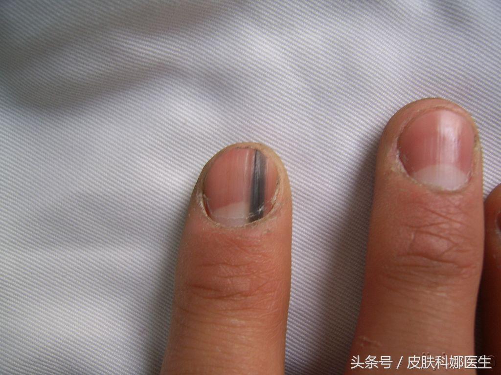 指甲上有很短的黑色线怎么回事,指甲上面出现一条黑线