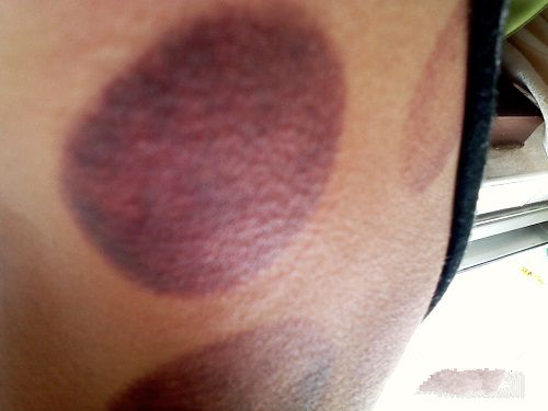 根据拔罐后皮肤的颜色鉴定你的身体到底是怎么了