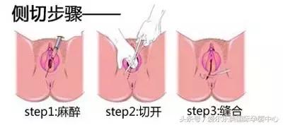 “医生，能不能不剪开啊，我怕变松……”