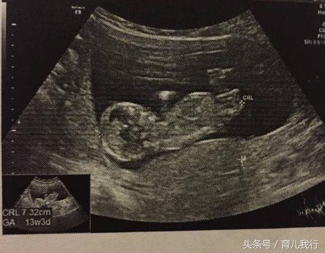 b超单子怎么看胎位正常,b超单子在哪里看胎位正不正