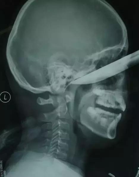 X光片里的体内异物，简直大开眼界