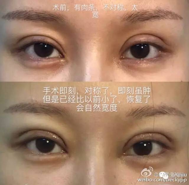网红做双眼皮变化,整双眼皮成功的网红