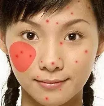 各个地方长痘的原因以及解决方法,长痘到底是什么病啊