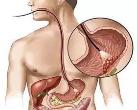 名家专栏︳“酸”相关疾病,不注意说不定你就是下一个患者