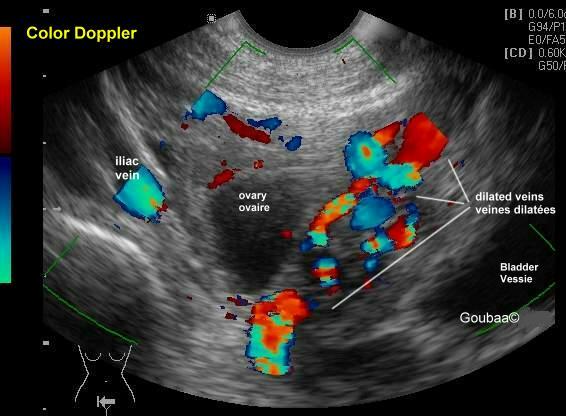 左下腹痛会是静脉曲张吗,动脉曲张与肚子疼
