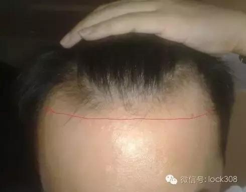 前额头脂溢性脱发最佳治疗方法,头发中间秃了怎么回事脂溢性脱发