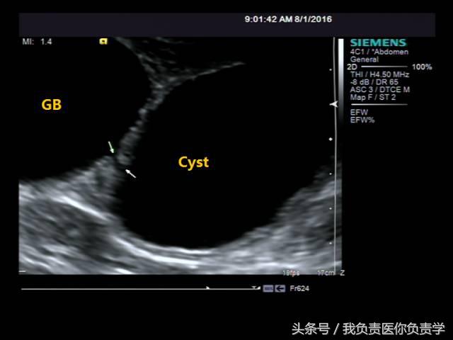 楂樻墜杩涢樁鑵拌吂璁粌,鑳嗗泭缁撶煶绌垮瓟鐥囩姸