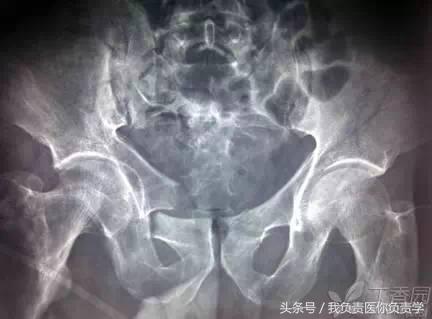 正常骨盆x线片详解,骨科医生只看报告单