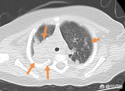 孩子得了肺炎一定要输液吗？医生：请避开这9个认知误区