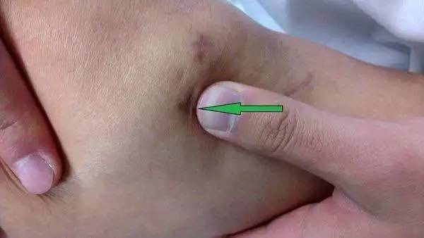 肘关节骨折僵硬锻炼之后手没力,肘关节撕裂骨折后关节响声