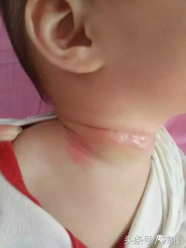 宝宝脖子淹了破皮红了怎么办,新生儿脖子淹了破皮用氧化锌软膏