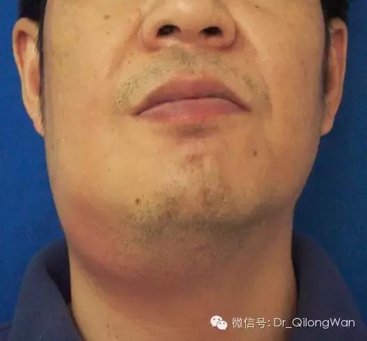 牙疼引起的颌下间隙感染,牙疼不是病有什么办法治呀