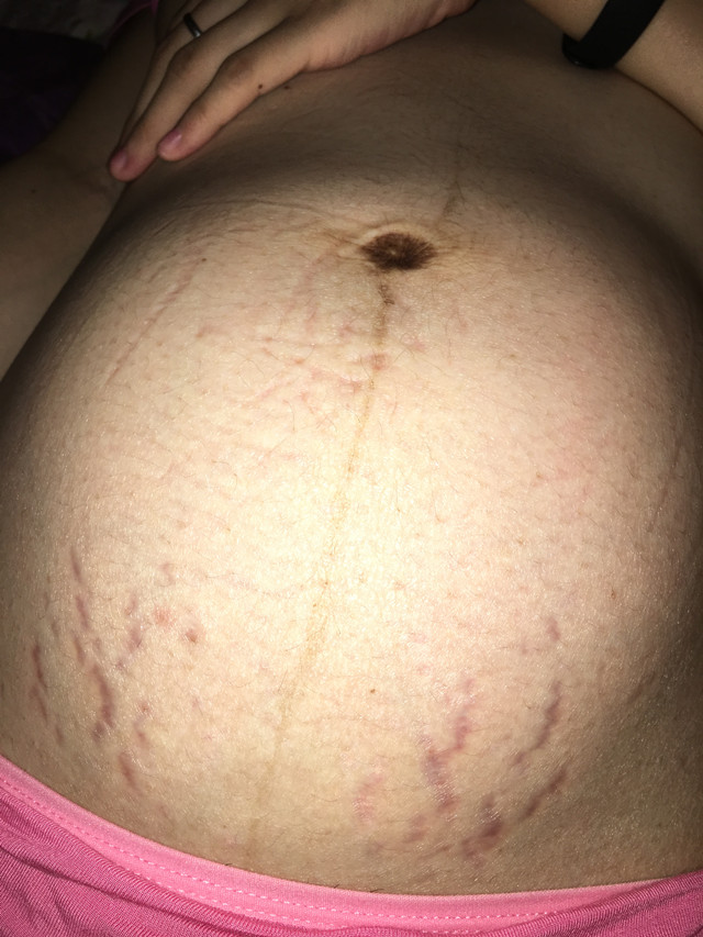 怀孕七个月长妊娠纹了还能补救吗,孕一个月就长妊娠纹了