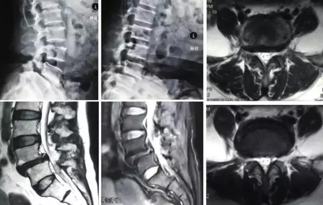 骨伤科可以治疗腰椎滑脱吗,腰椎滑脱微创术后需要康复训练吗