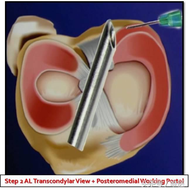 膝关节内侧后角半月板1度损伤,右膝关节内侧半月板后角变性损伤