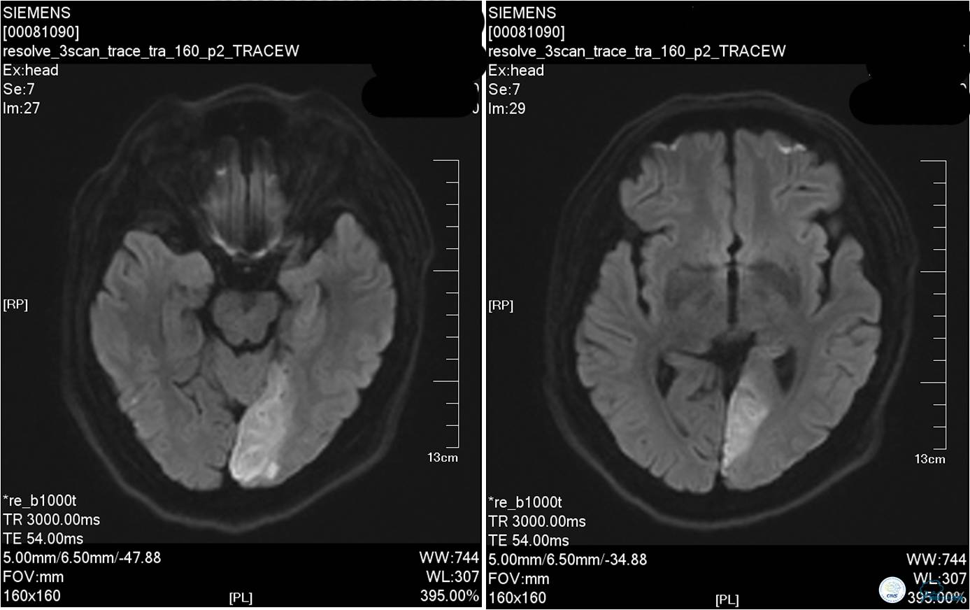 中医治疗基底动脉闭塞,基底动脉尖综合征病例分享