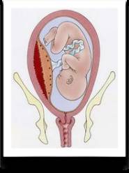 中央性前置胎盘为什么会大出血,前置胎盘16周大出血很多血块