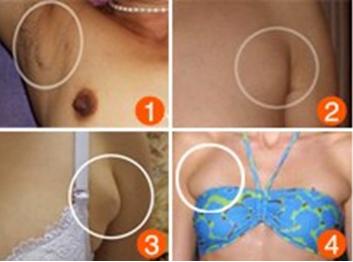 腋窝下有淋巴结会引起乳腺癌吗,腋下淋巴结会是乳腺癌吗