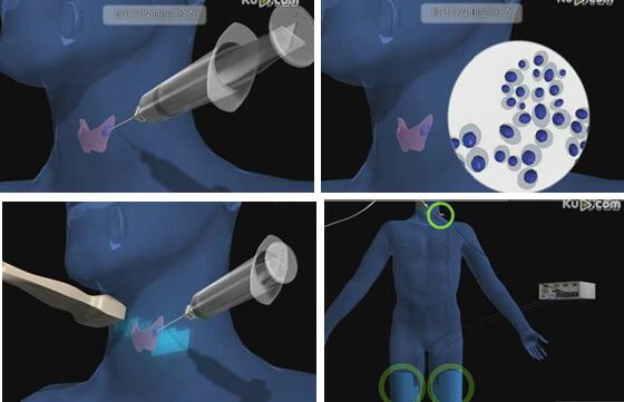 甲状腺手术用胶水粘伤口怎么护理,甲状腺手术后伤口怎么护理