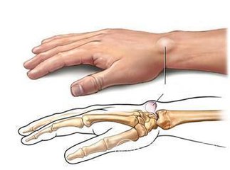 专家讲腱鞘炎疾病的视频,医生讲解腱鞘炎治疗方法