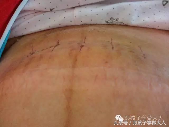 剖腹产8大禁忌,剖腹产后注意事项及禁忌