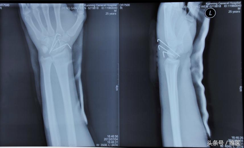 月骨舟骨半脱位手术,手腕舟骨月骨周围脱位要多久康复