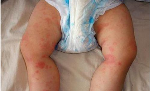 湿疹还有点皮肤硬用什么药,婴幼儿身体湿疹怎么护理