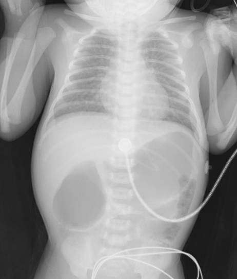 宝宝严重低钠血症,低钠血症的病因是什么如何治疗