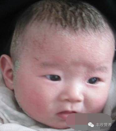 治疗宝宝湿疹家长请收好调理食谱,宝宝湿疹怎么给宝妈解释