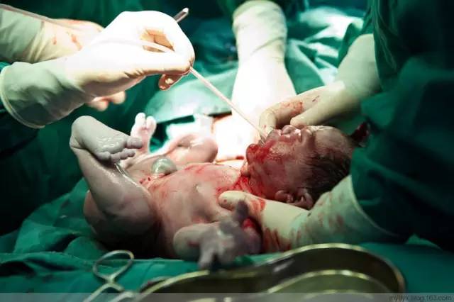 剖腹产恢复很好的照片,剖腹产完全恢复照片