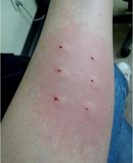 有胎停史再次怀孕有必要查免疫么,胎停免疫治疗多少钱一次