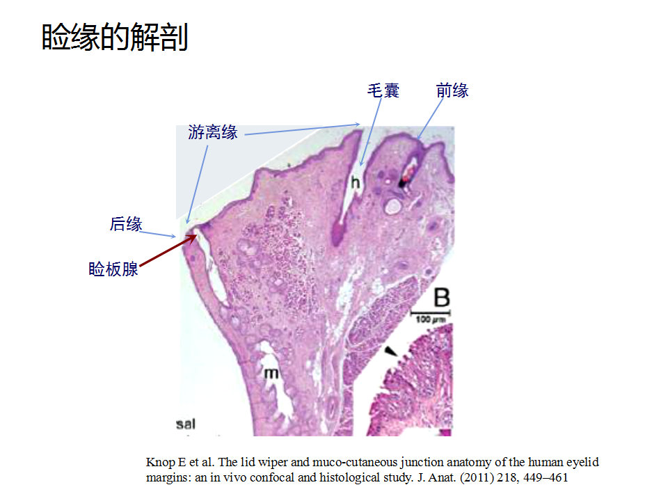 眼睑缘炎的发病原因,眼睑炎的症状和治疗方法