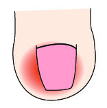 指甲竖纹里面有白点是什么原因,指甲有竖纹和白点是怎么回事