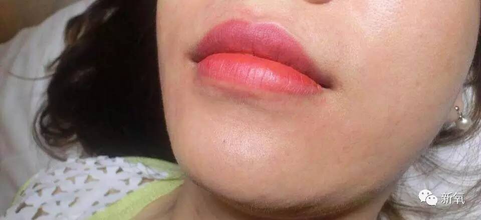 瞒着家人做了美瞳线,做美瞳线为什么会引起角膜炎