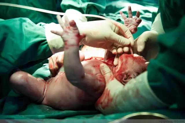 剖腹产恢复很好的照片,剖腹产完全恢复照片