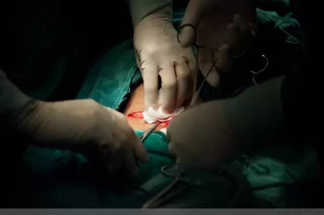 剖腹产恢复很好的照片,剖腹产完全恢复照片