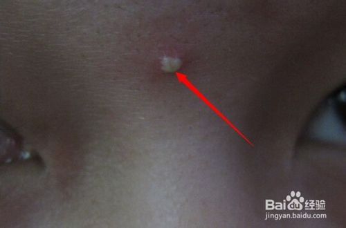 怎样消除青春痘和粉刺最快的方式,如何有效祛除青春痘