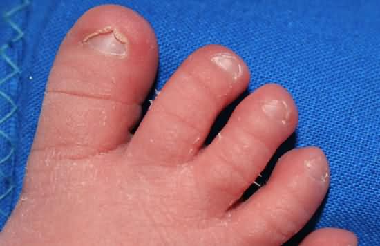 指甲往肉里长太疼了教你简单一招,指甲长肉里怎么治疗才能彻底除根
