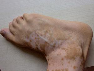 308激光治疗白癜风医保报销吗,uvb和308治疗白癜风哪个效果好