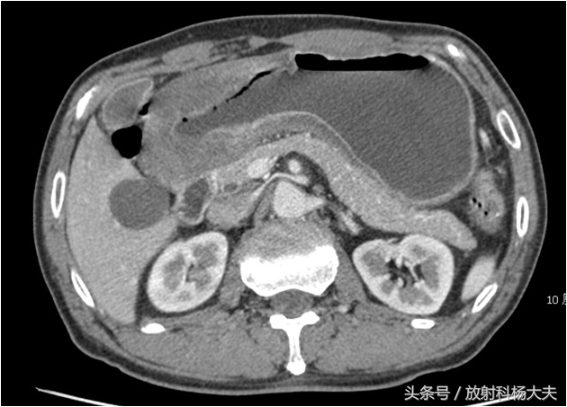 胃癌肝转移还贫血能化疗吗,无任何症状突然重度贫血