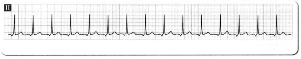 服用什么药物心电图就会正常,服药后做心电图