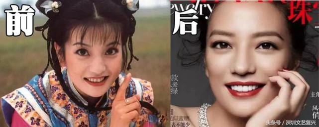 林允整牙效果怎么样,林允整牙后变化图片