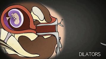 人工流产、药物流产哪种流产更安全？