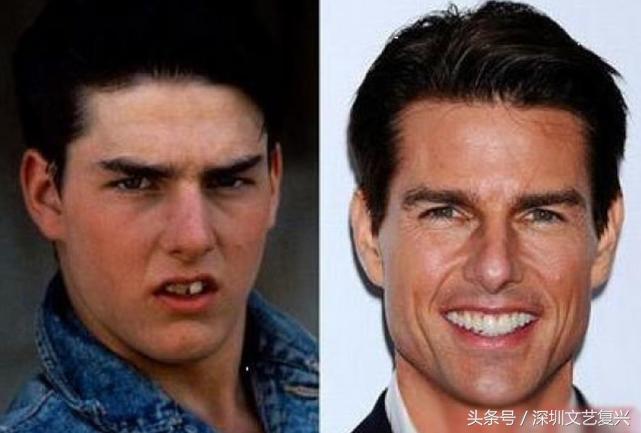 林允整牙效果怎么样,林允整牙后变化图片